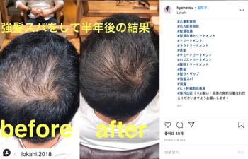 줄기세포발모제 후기(시스hsc / hsc15) - 지예가(판매처)