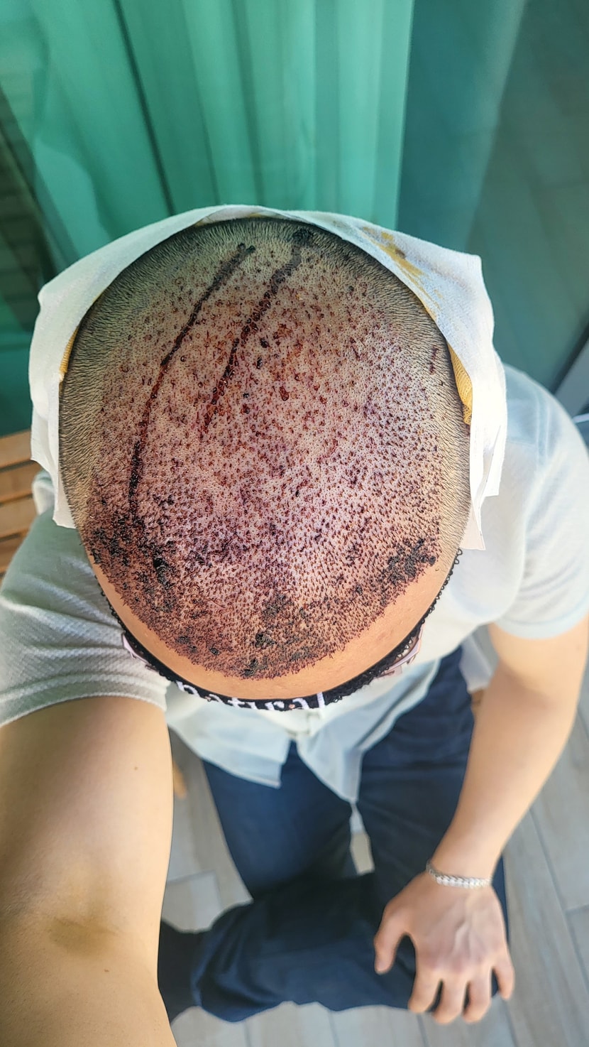 터키 모발이식 상담