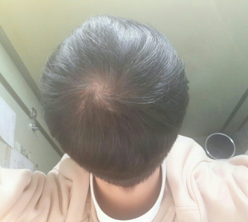 두피 문신 효과 있을까요 ?