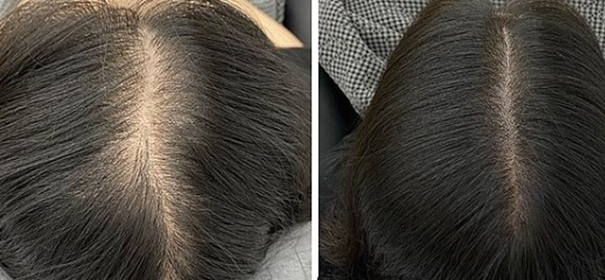 광주에서 두피문신 하고 드디어 자신있게 다닐수있네요~