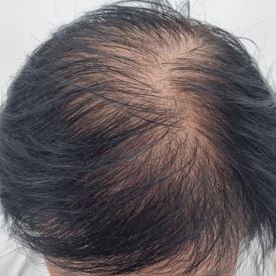 두피문신 정말 솔직한 후기