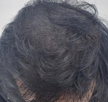 파마를 하긴 했지만 확실히 두피가 어두워져서 탈모가 감춰집니다