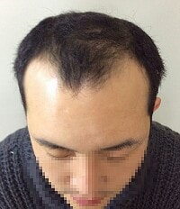 今日二次施術しましたw