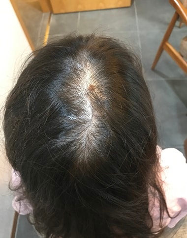 뉴헤어 두피문신