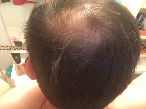 smp 시술 후 경과 사진 올립니다.