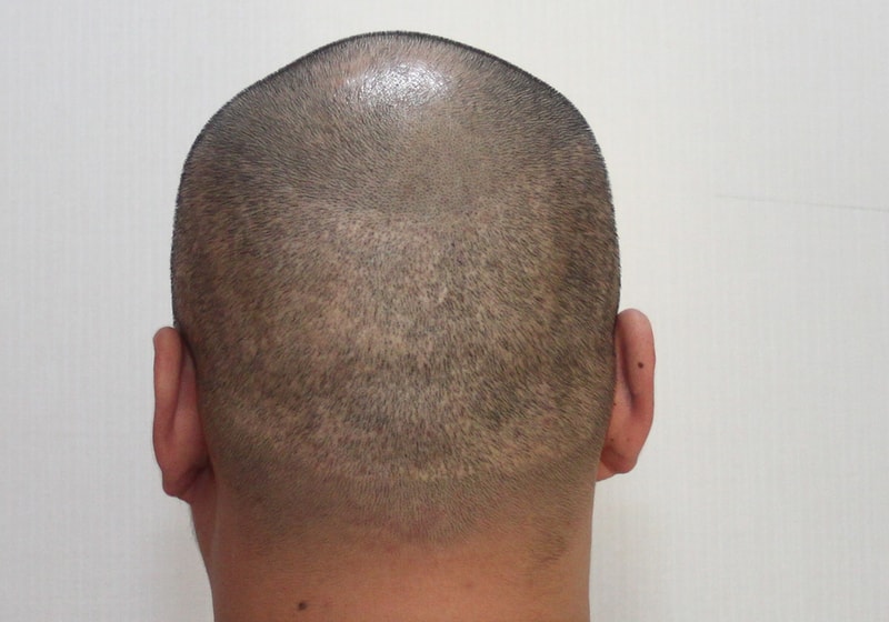 비절개모발이식 후 채취 상처부위 두피문신했어요