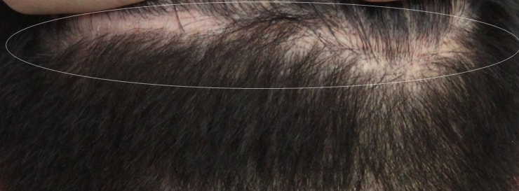 이식 흉터에 두피문신 후기 ~