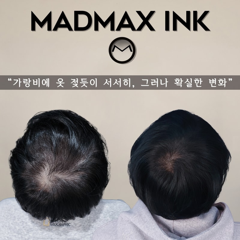 천안두피문신 매드맥스잉크, 탈모인들이 선택하는 이유