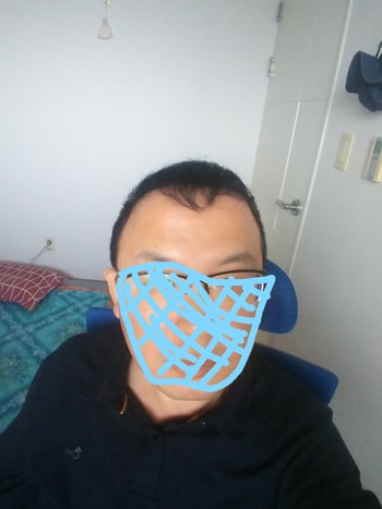 2018년 모발이식 1년후 사진