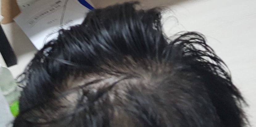 18년 짧은머리 가마 미녹시딜 투여