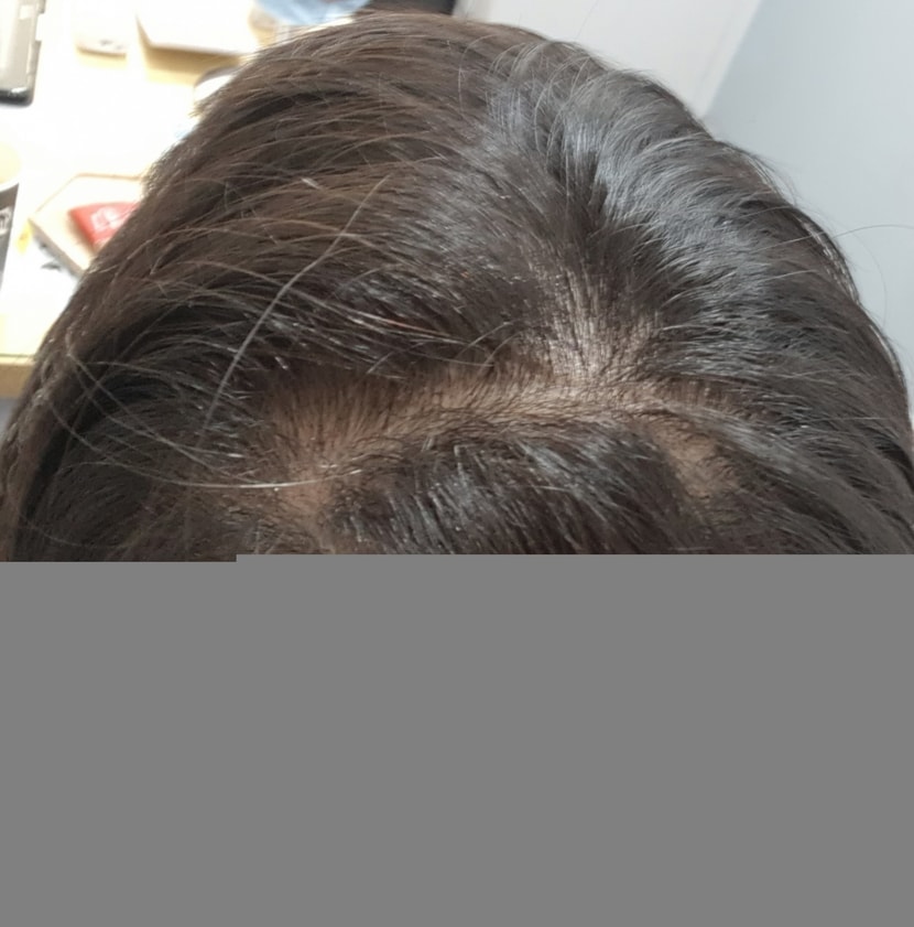 19년 8월 2일 최근 증모술 후 가마가림없이