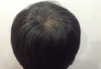 정수리 (후)