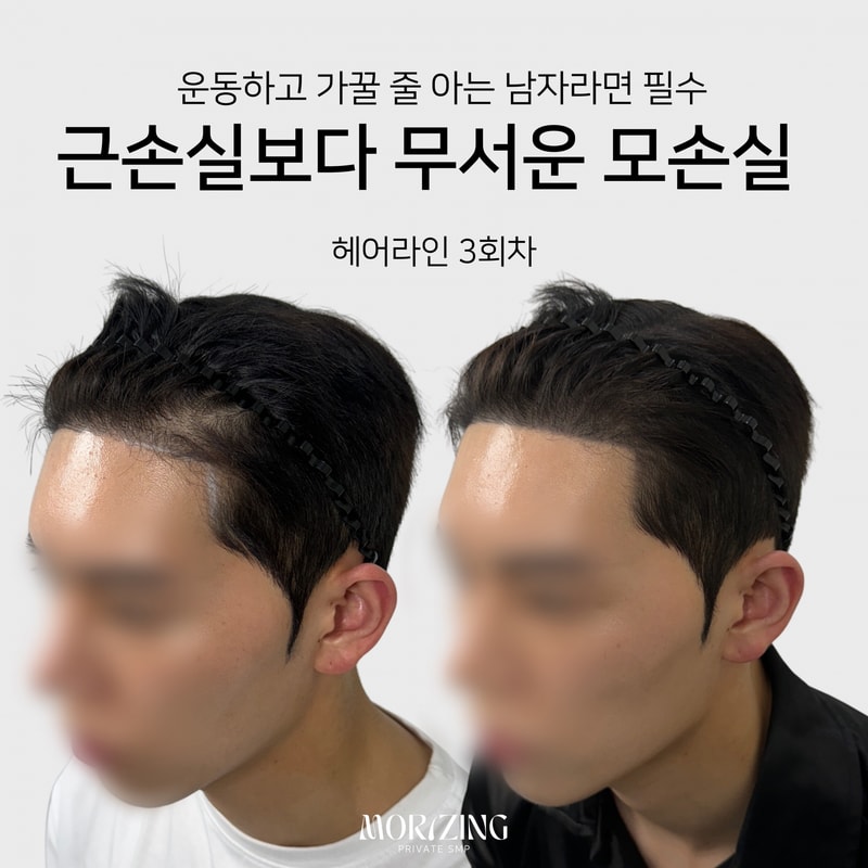 서울 최대한 자연스러운 두피문신 찾으시나요?!