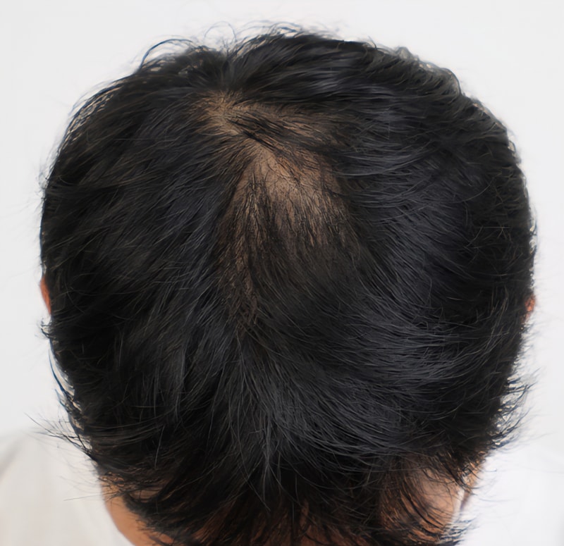 终于脱发毕业了！