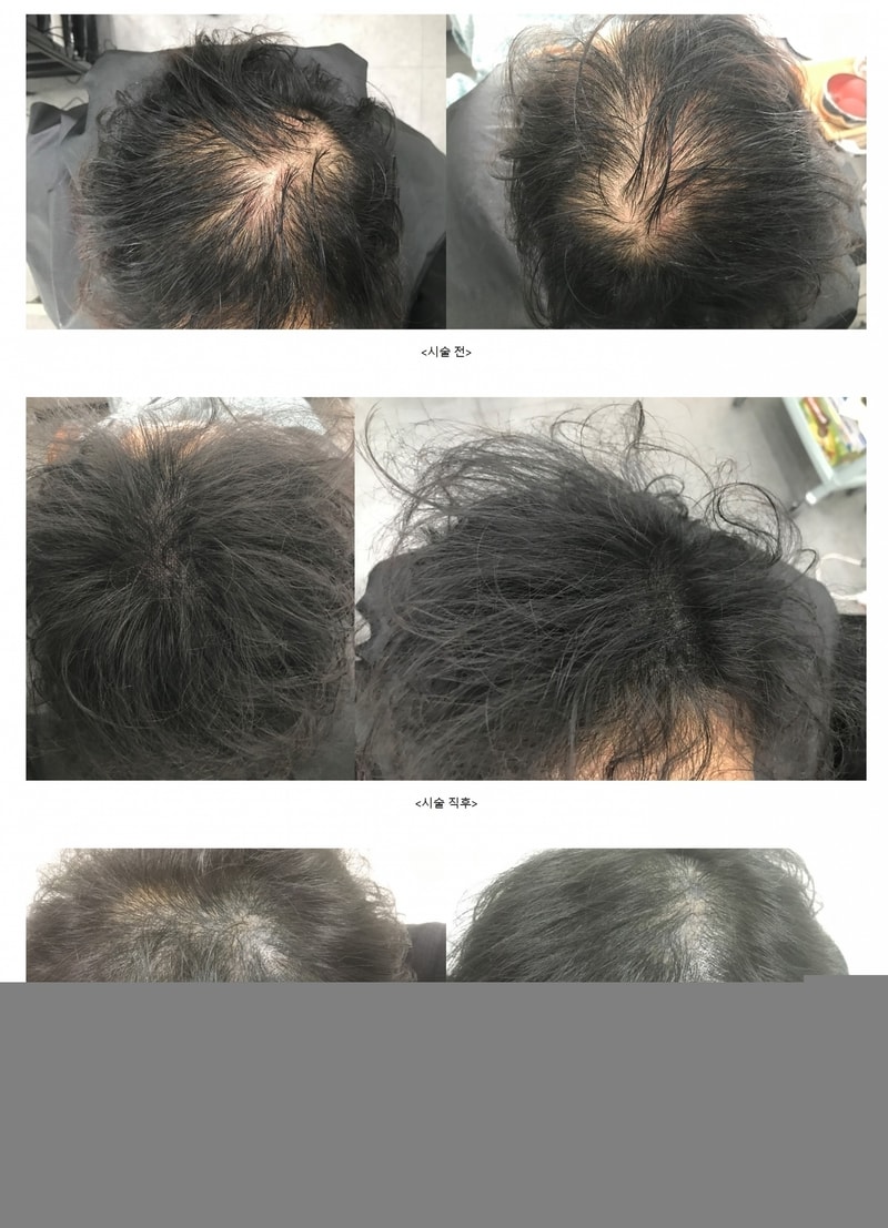 额头头顶头皮纹身手术后期（当天前后，10个月）