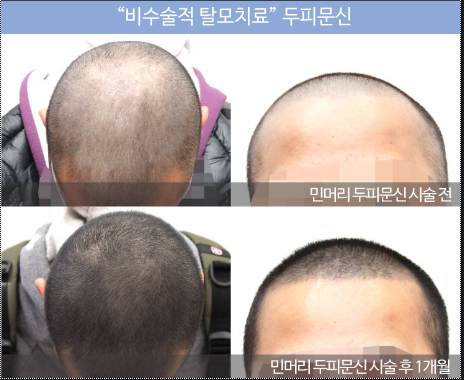 민머리 두피커버술 질문ㅠ ㅠ