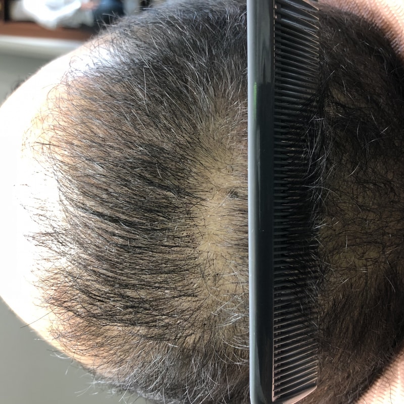 这是釜山庆星大学SMP头皮纹身第一次后记