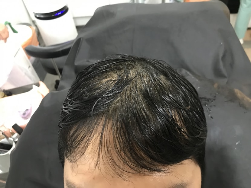 시술전 시술후
