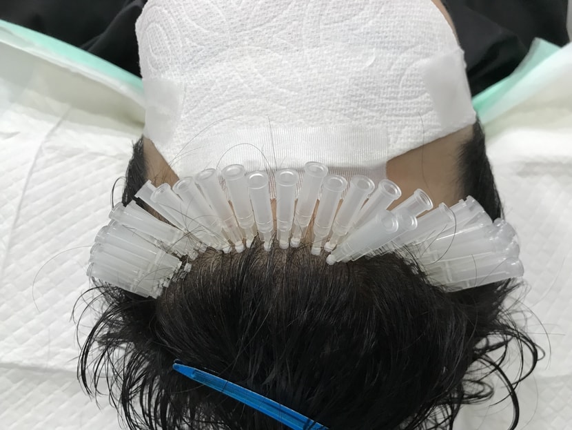 잔머리재생술