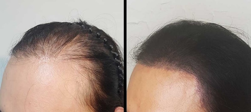 모발이식 생착실패로 두피문신을 했네요