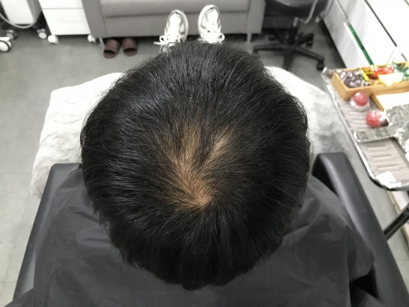 시술전