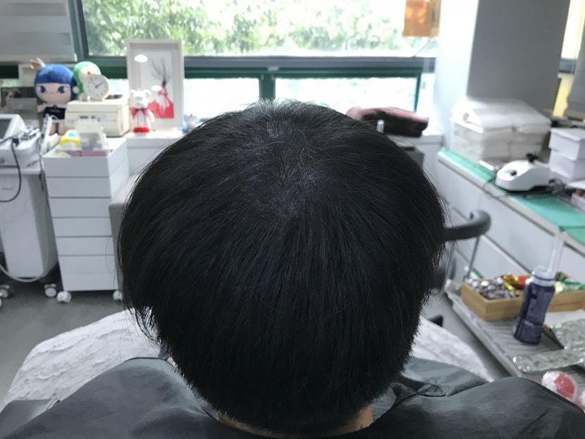 시술후