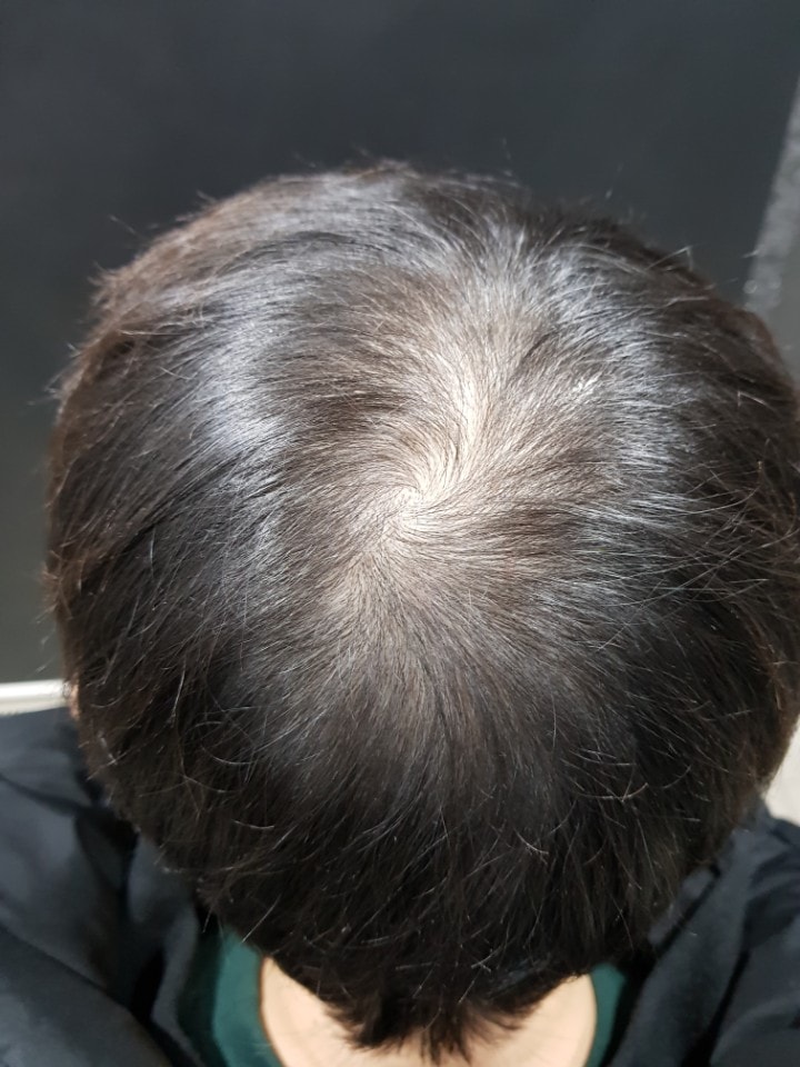 시술전