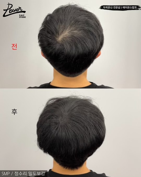 시술 전 후 업체에서 찍어주신 사진입니다(보정x)