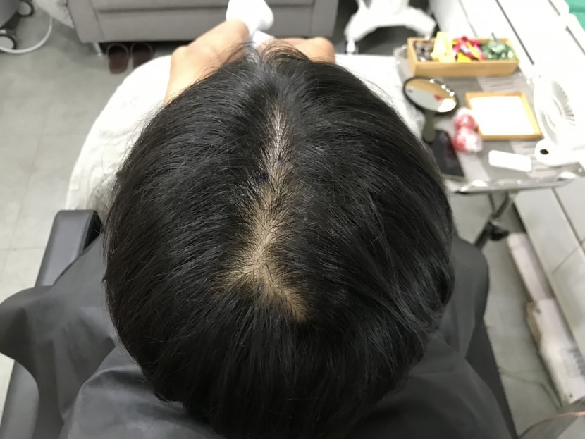 두피문신 전