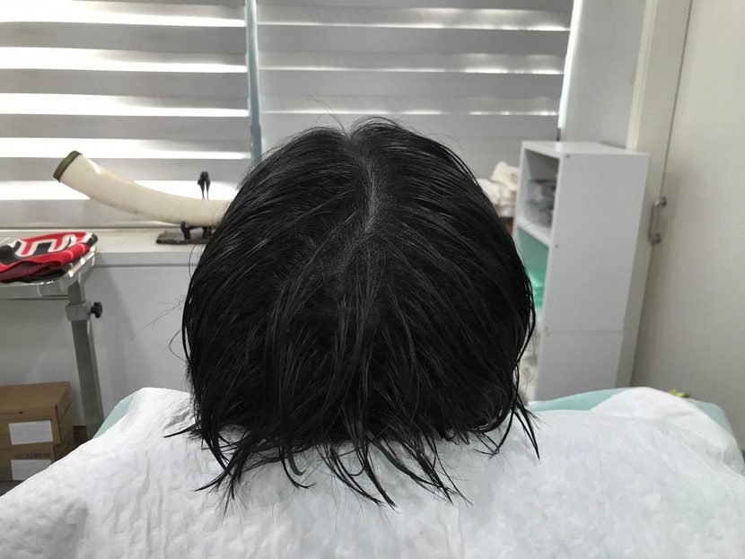 두피문신 후