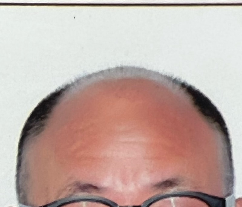 두피 문신 받았습니다 ~