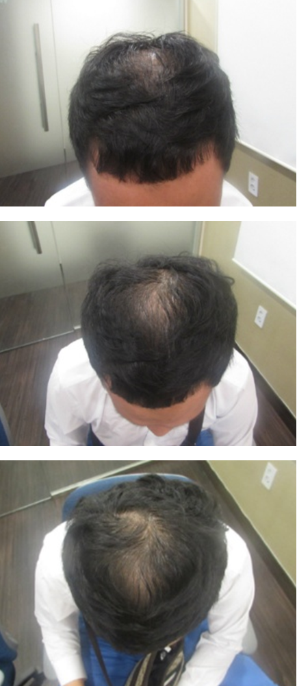 안녕하세요~두피문신(정수리+윗부분)후기올려요.