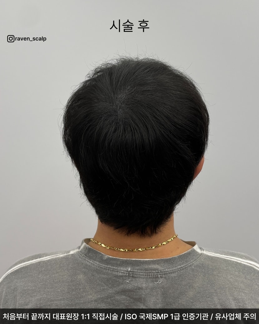 시술 후