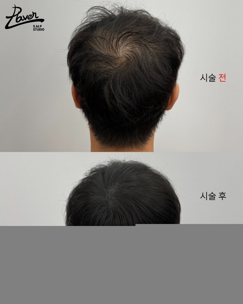 정수리 두피문신