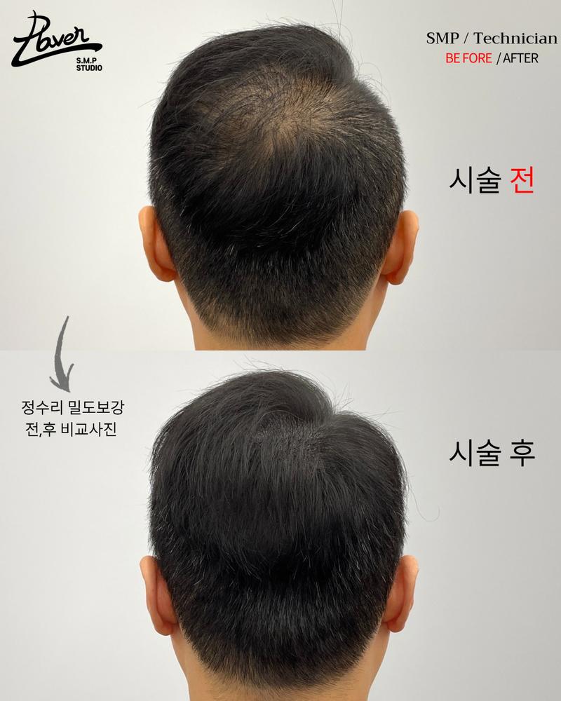대구 정수리탈모 두피문신으로 해결가능할까요?