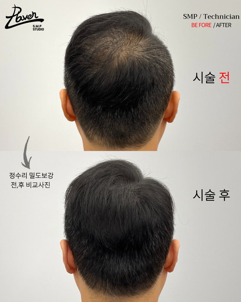 정수리 두피문신 전,후 비교사진