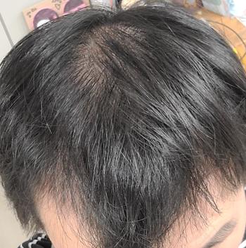 정수리부분