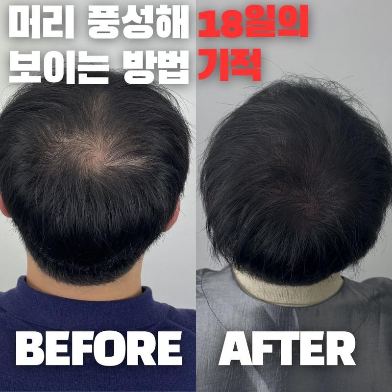 男性头顶永久性的黑彩？