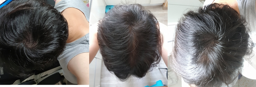 리터치후
