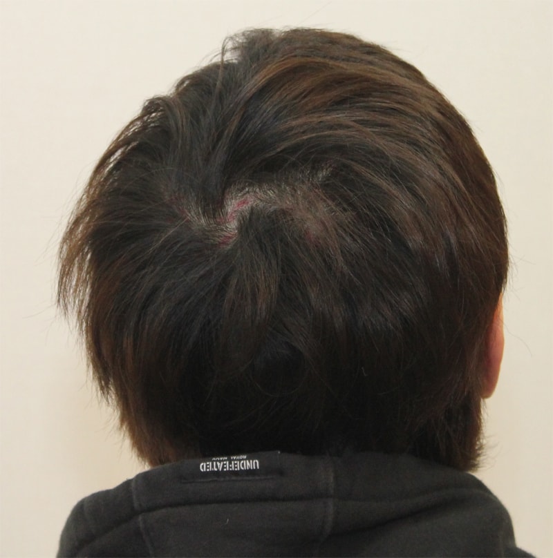 nhi뉴헤어 smp 포토후기