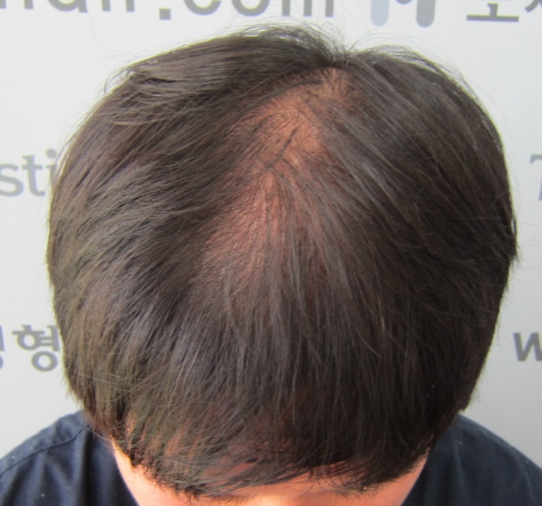 두피문신 받은지 45일 모재성 성형외과에서 받음