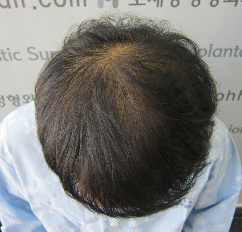 모재성 모발이식에서 두피문신하고 두달반정도 됬네요