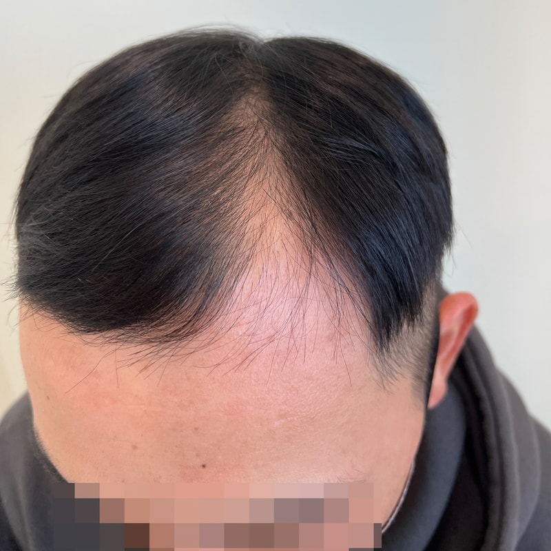 나중에 모발이식은 생각중인데요.. 일단 두피문신 해버렸습니다~! ㅎㅎ