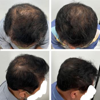 왼쪽 비포 / 오른쪽 에프터 (비포랑 가르마가 달라서 에프터 많이 어두워 보인다고 하셨는데 그래도 차이가 나긴 하네요)