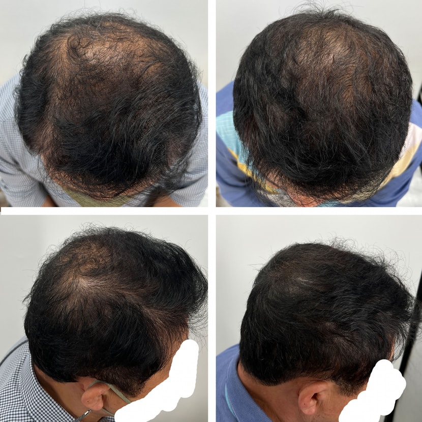 왼쪽 비포 / 오른쪽 에프터 (비포랑 가르마가 달라서 에프터 많이 어두워 보인다고 하셨는데 그래도 차이가 나긴 하네요)