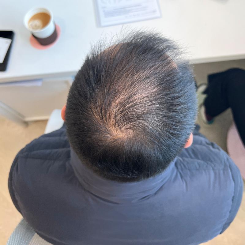 두피문신 상담 받고 왔습니다..