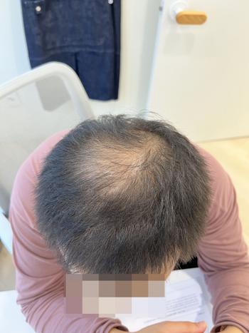 이게 42살의 머리...머리만 보면 60대 같습니다..