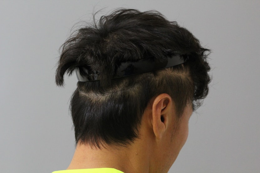시술  후1.