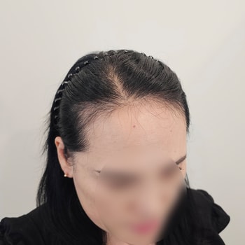 비포