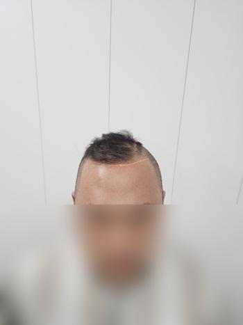 머리를 이렇게 밀어놔서 좀 티가 덜나서 그렇지 엠자가 꽤 올라갔네요;;